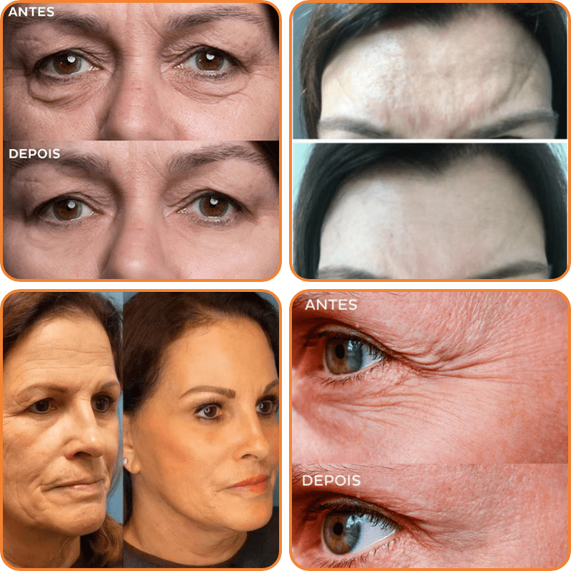 Collagen Skin Botox™ - Colágeno + Ácido Hialurônico OFERTA 🎁 (50% DE DESCONTO) + BRINDE