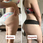 Drena Roller – Massageador Linfático para Lipedema e Celulite