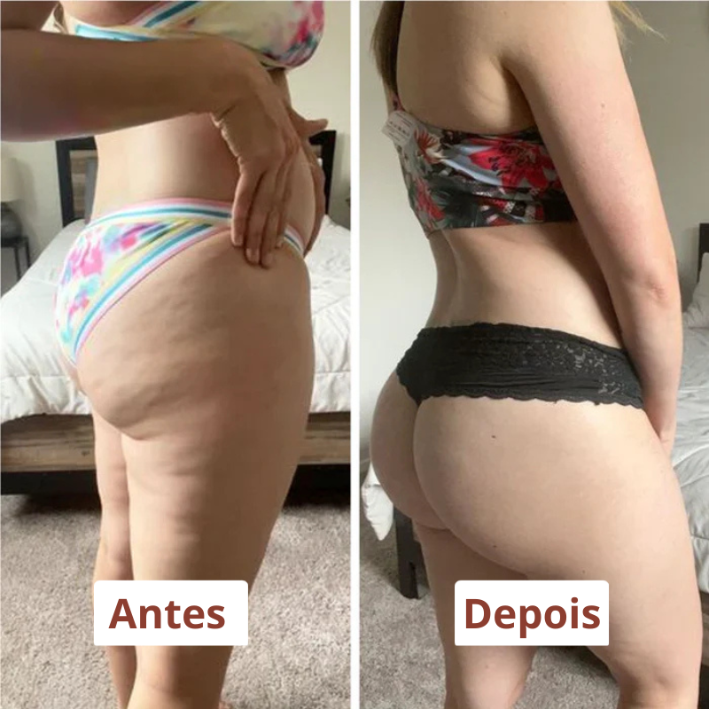 Drena Roller – Massageador Linfático para Lipedema e Celulite