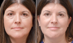 BotoxLux™ Creme Lifting com Peptídeos