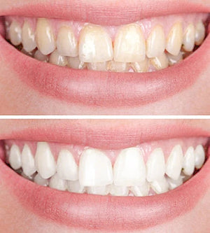 Clareador Dental Viya White  - PROMOÇÃO DE DIA DAS MÃES (50% DE DESCONTO)