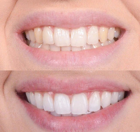 Clareador Dental Viya White  - PROMOÇÃO DE DIA DAS MÃES (50% DE DESCONTO)