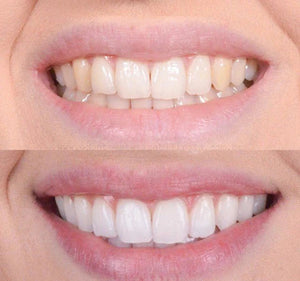 Clareador Dental Viya White  - PROMOÇÃO DE DIA DAS MÃES (50% DE DESCONTO)