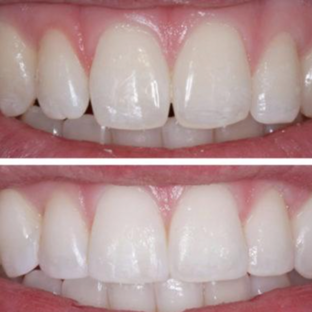 KIT de Reparação de Dentes HiSmile | Os dentes mais bonitos em poucos minutos!