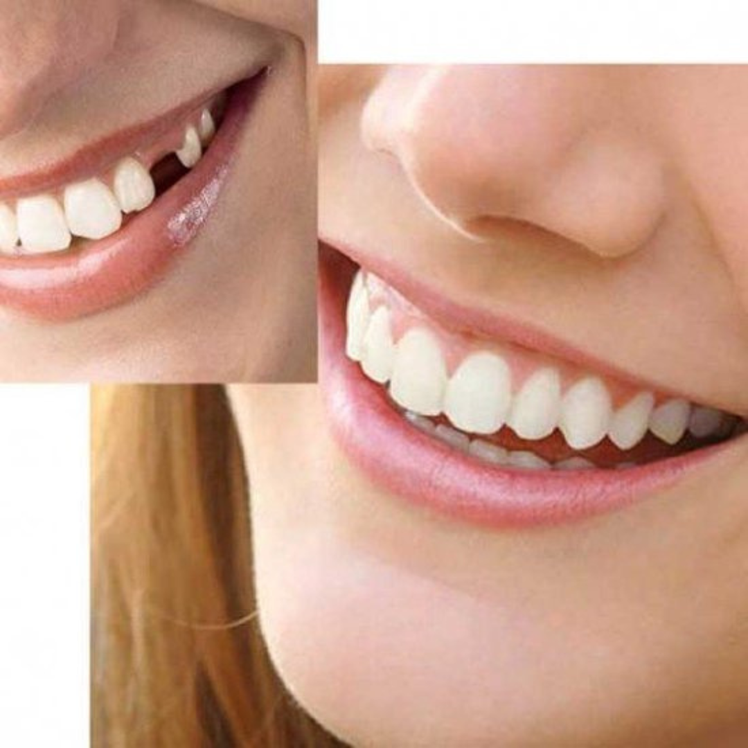 KIT de Reparação de Dentes HiSmile | Os dentes mais bonitos em poucos minutos!