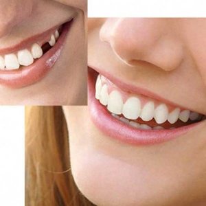 KIT de Reparação de Dentes HiSmile | Os dentes mais bonitos em poucos minutos!