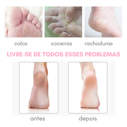 Removedor de Calos e Rachaduras dos Pés - Soft - viya-stores