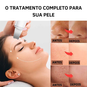 Aparelho Peeling Ultrassônico Limpeza Facial – Pele Radiante - viya-stores