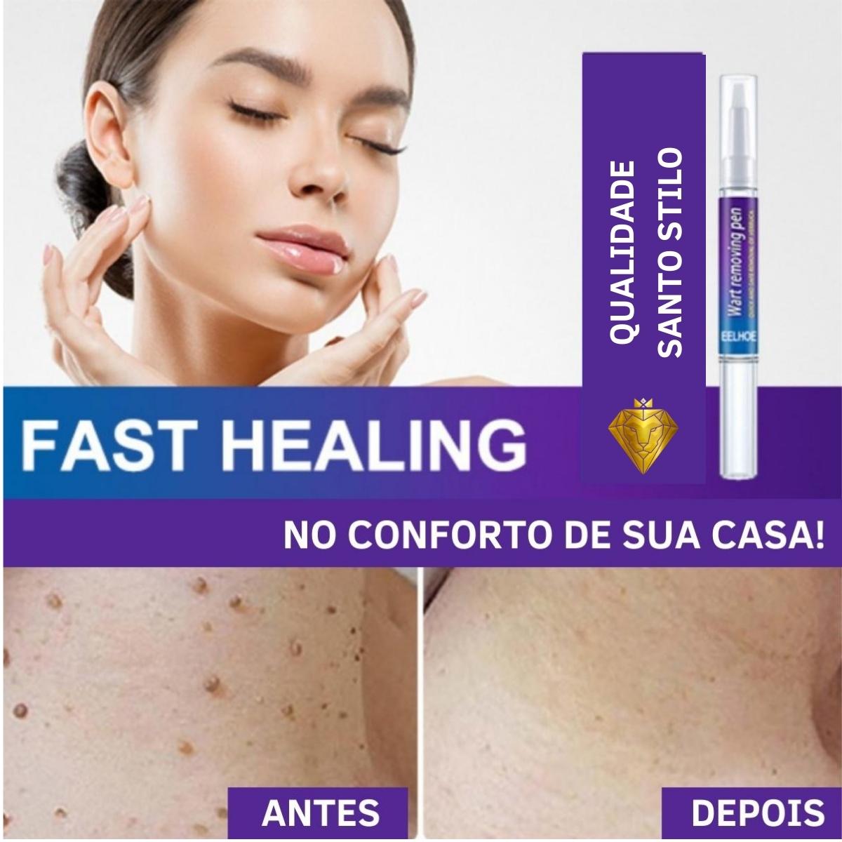 Creme Removedor de Verrugas – Fast Healing - viya-stores