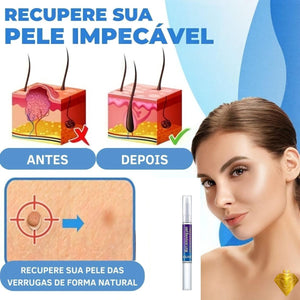 Creme Removedor de Verrugas – Fast Healing - viya-stores