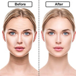 Adesivos de Silicone Anti Rugas e Linhas de Expressão - RevonaSkin™ - viya-stores