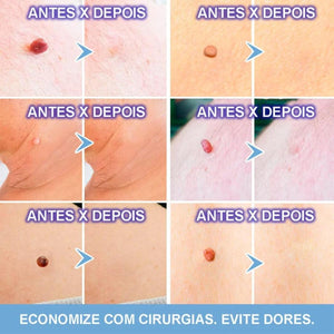 Creme Removedor de Verrugas – Fast Healing - viya-stores