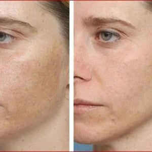 Aparelho Peeling Ultrassônico Limpeza Facial – Pele Radiante - viya-stores