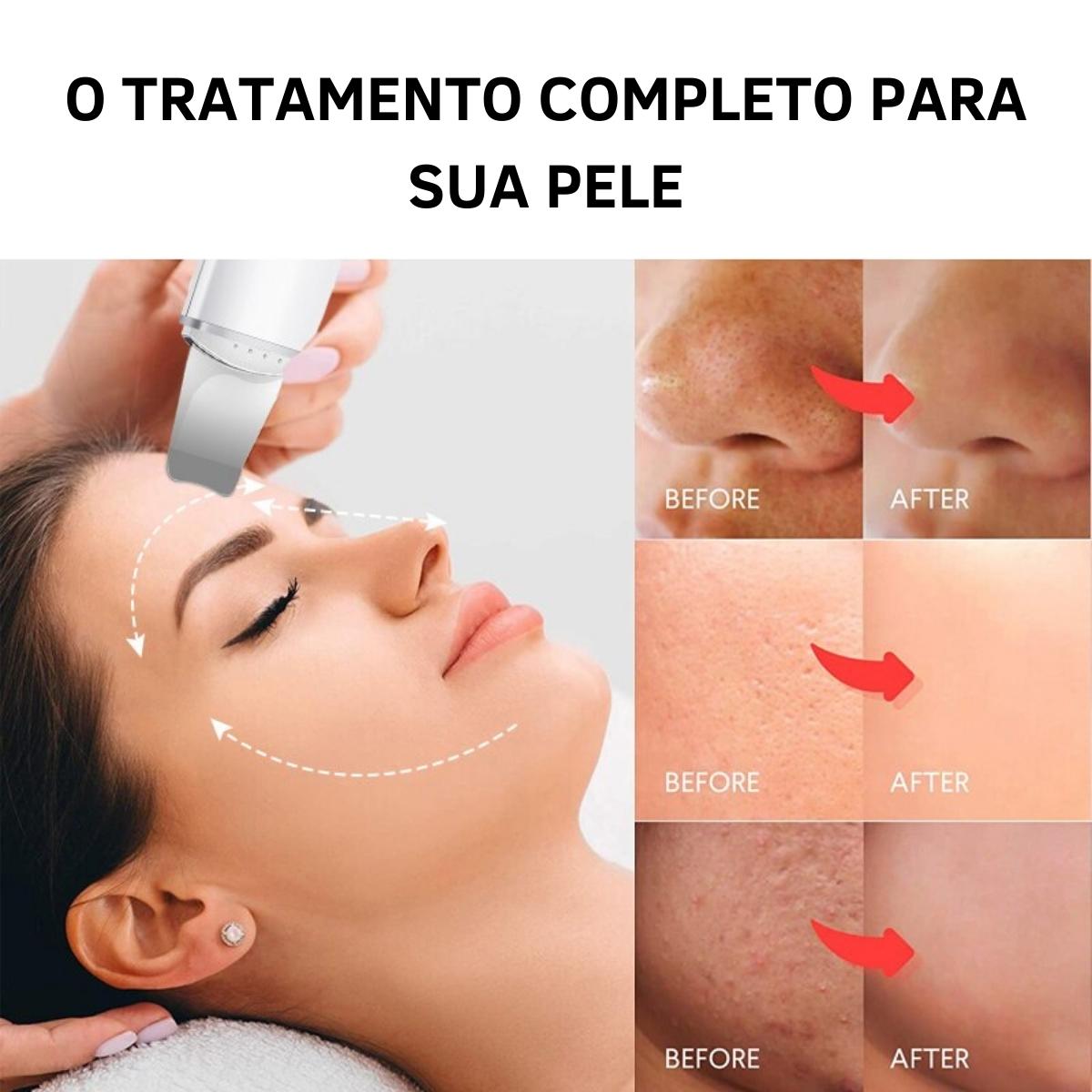 Aparelho Peeling Ultrassônico Limpeza Facial – Pele Radiante - viya-stores