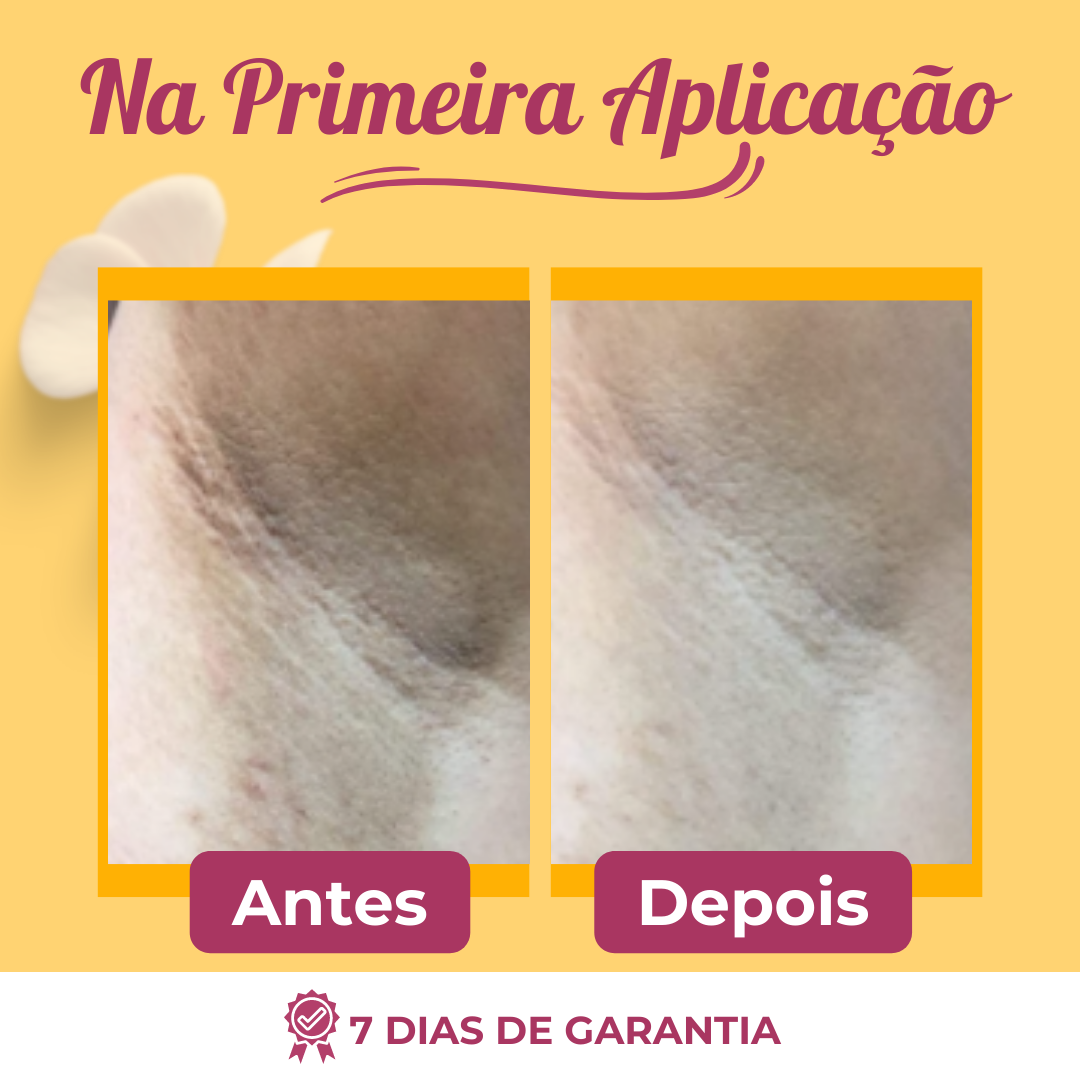 Retinou™ Creme Para Clareamento, Retire a Manchas Excessivas de Qualquer Região - Promoção Pré-Black Friday - viya-stores