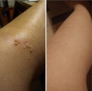 Creme Removedor de Verrugas – Fast Healing - viya-stores